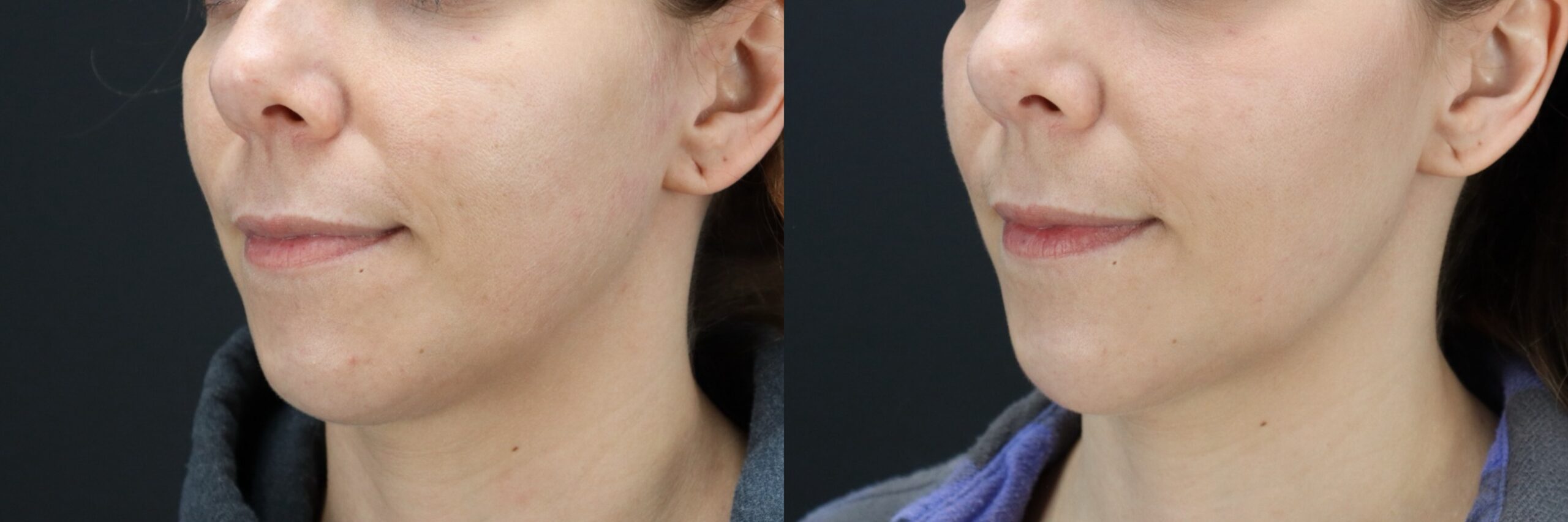 Before and after – Filler – Female patient, age 30-39 – Image 45