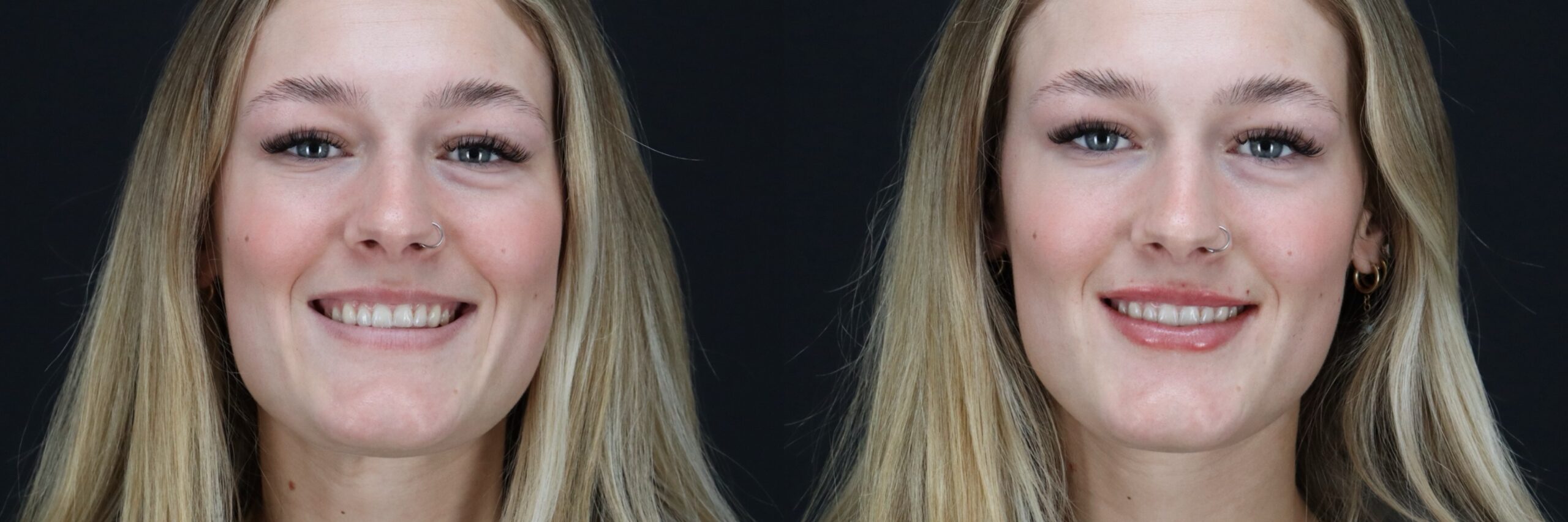 Before and after – Filler – Female patient, age 20-29 – Image 38