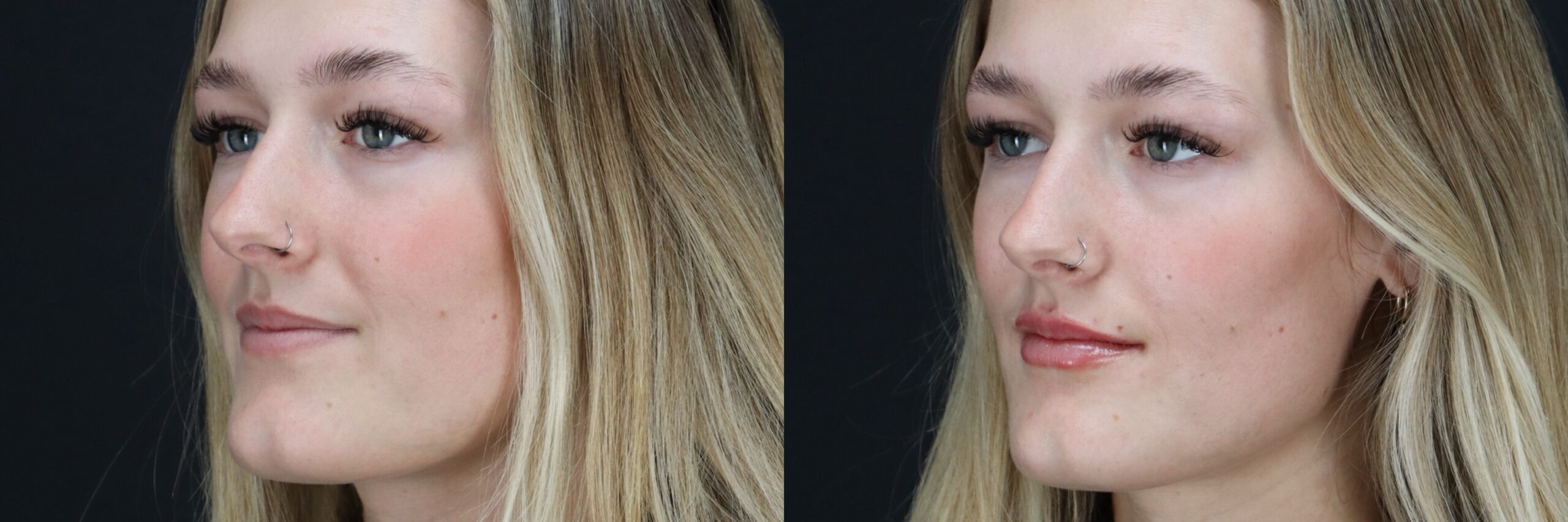 Before and after – Filler – Female patient, age 20-29 – Image 39