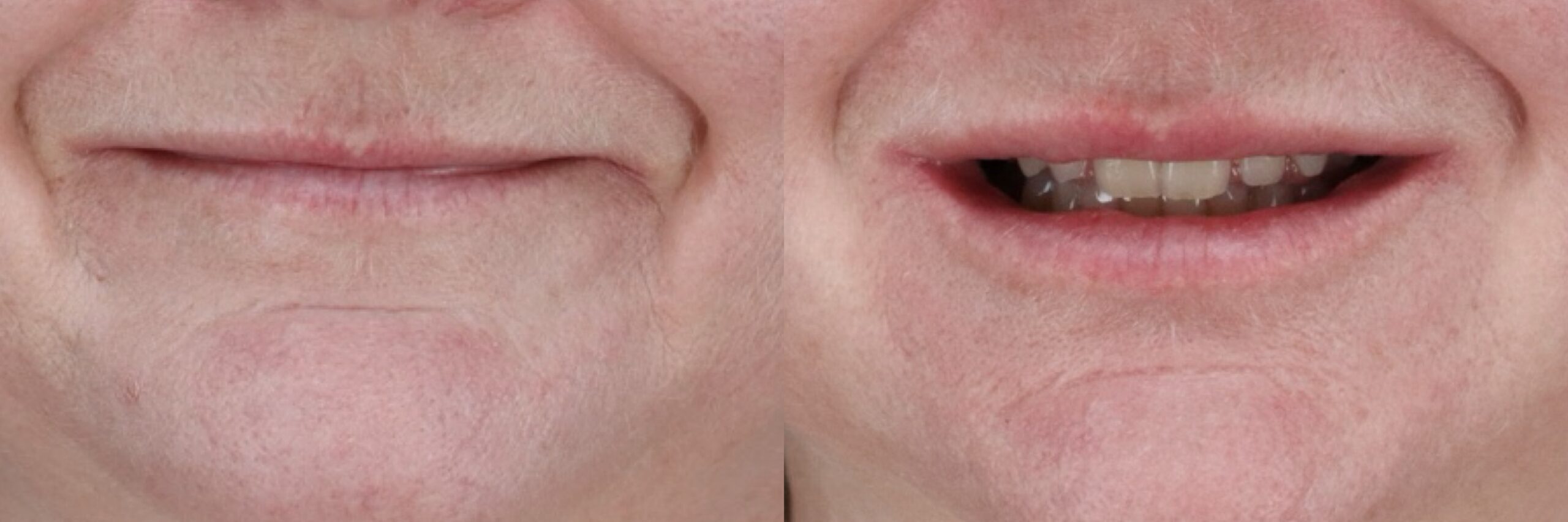 Before and after – Filler – Female patient, age 40-49 – Image 47