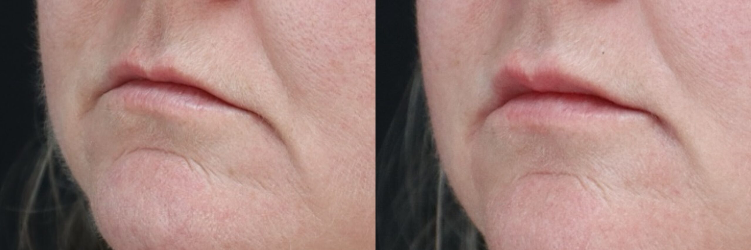 Before and after – Filler – Female patient, age 40-49 – Image 48