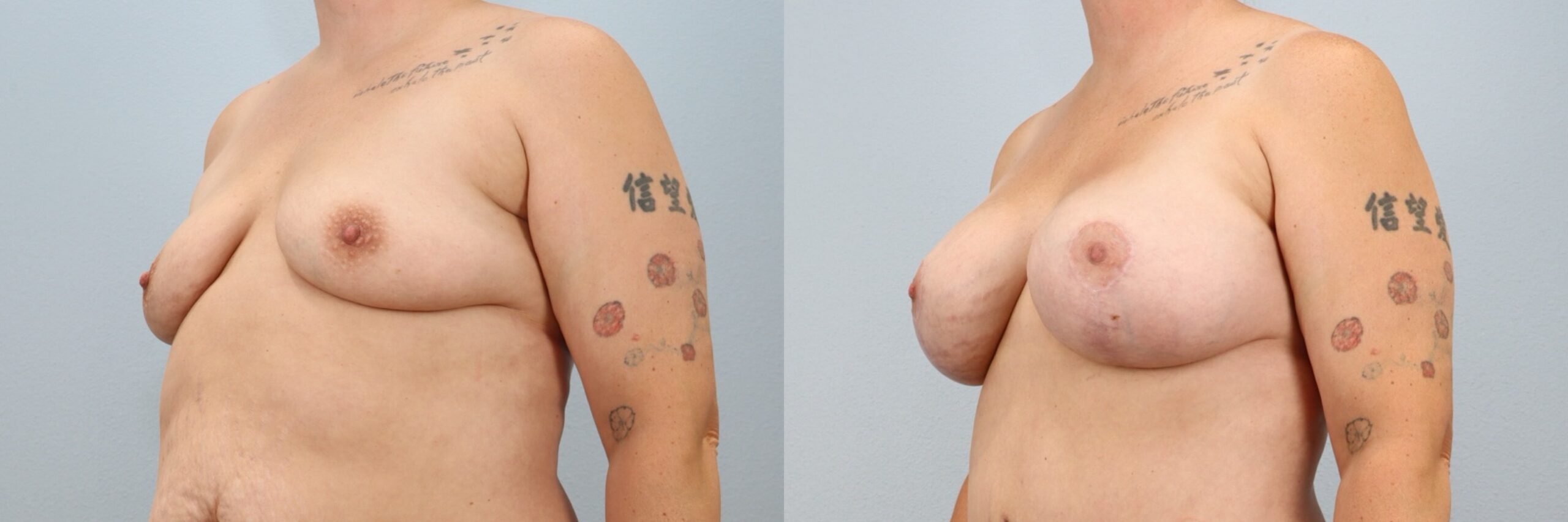 Before and after – Breast Lift With Implants – Female patient, age 30-39 – Image 41