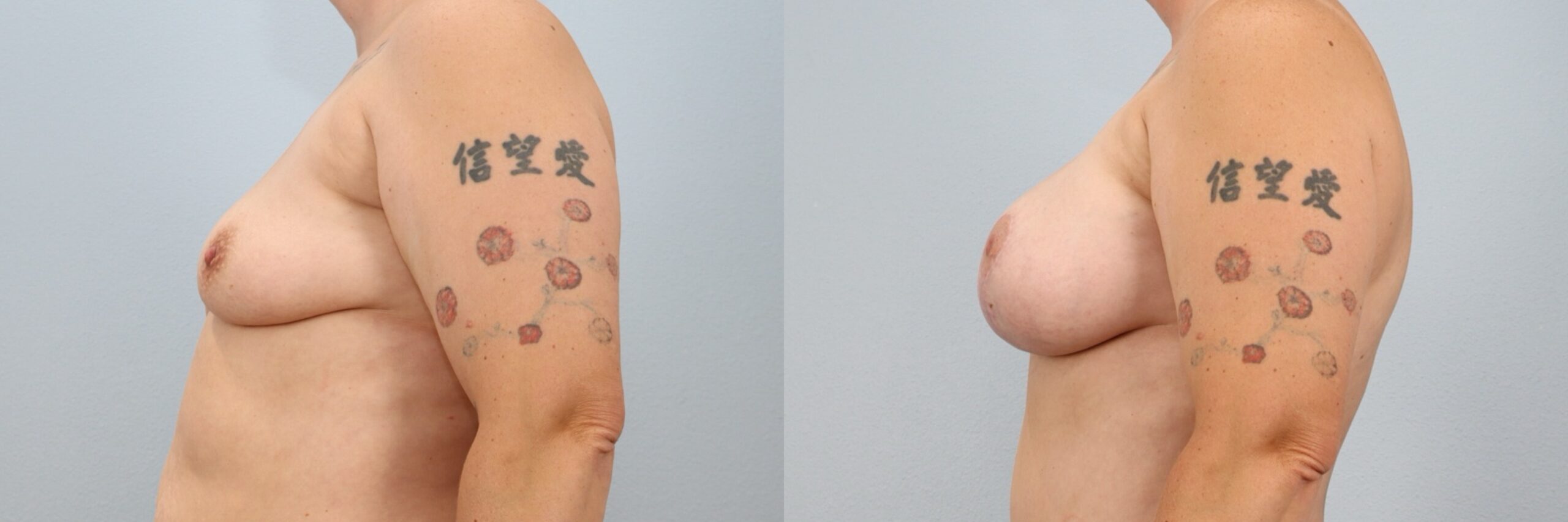 Before and after – Breast Lift With Implants – Female patient, age 30-39 – Image 42