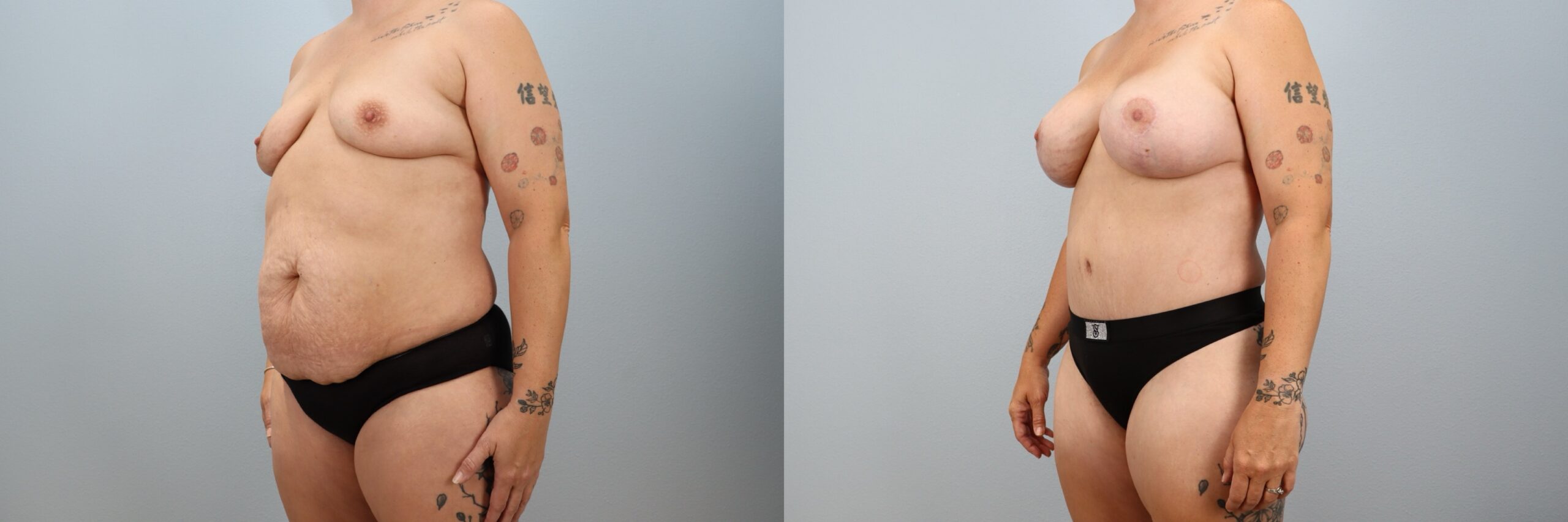 Before and after – Mommy Makeover – Female patient, age 30-39 – Image 47