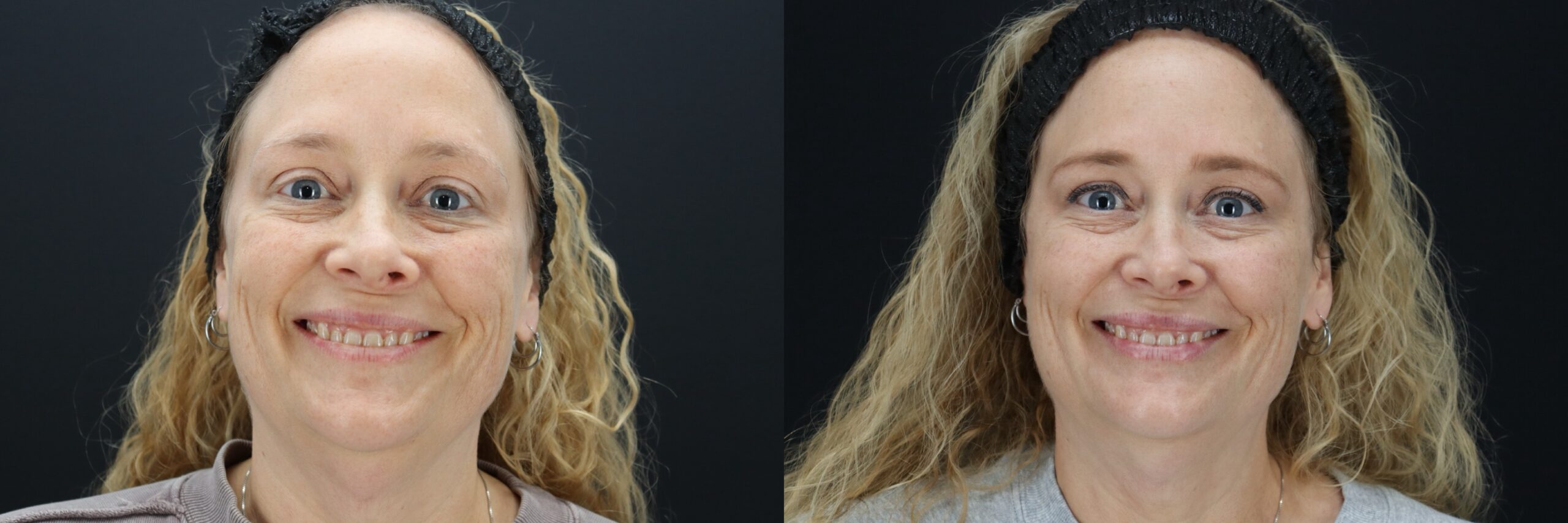Before and after – Filler – Female patient, age 40-49 – Image 32
