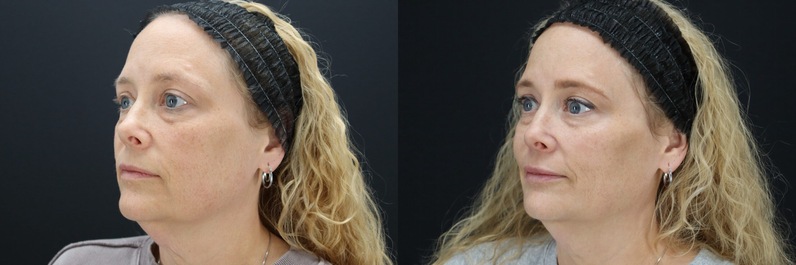 Before and after – Filler – Female patient, age 40-49 – Image 33