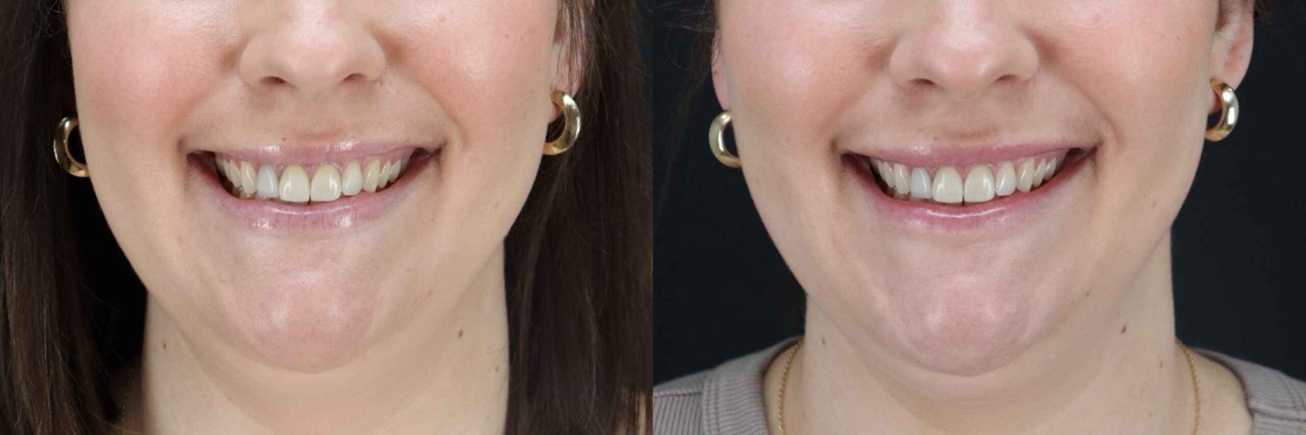 Before and after – Filler – Female patient, age 20-29 – Image 5