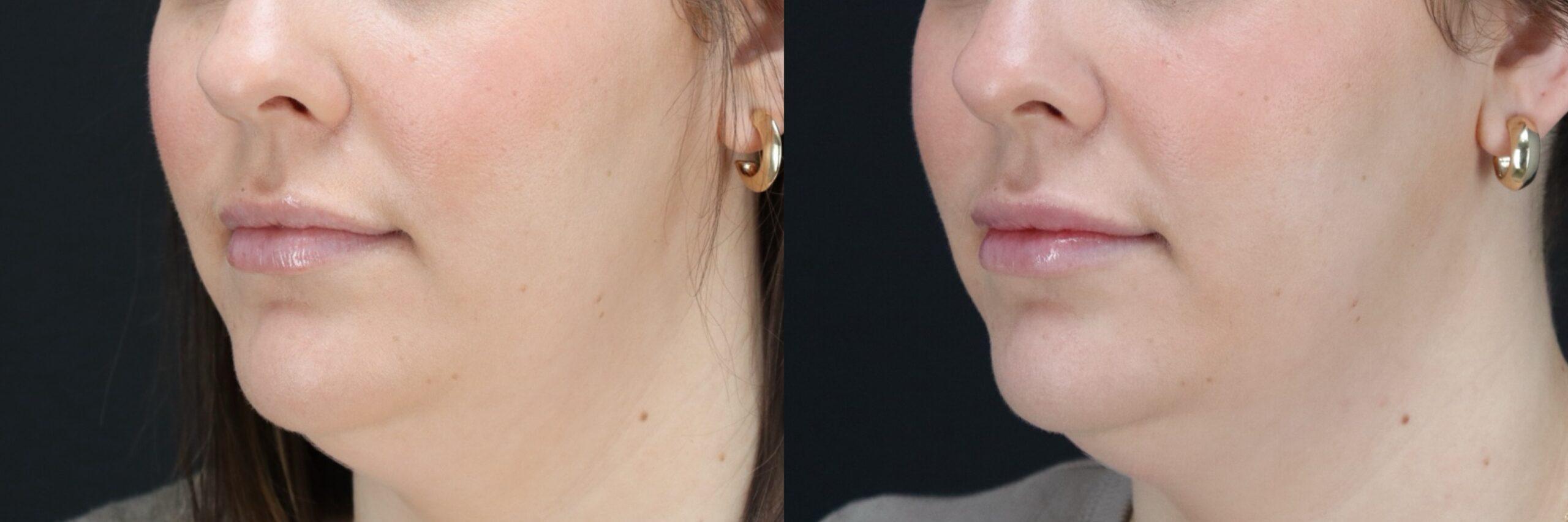 Before and after – Filler – Female patient, age 20-29 – Image 6