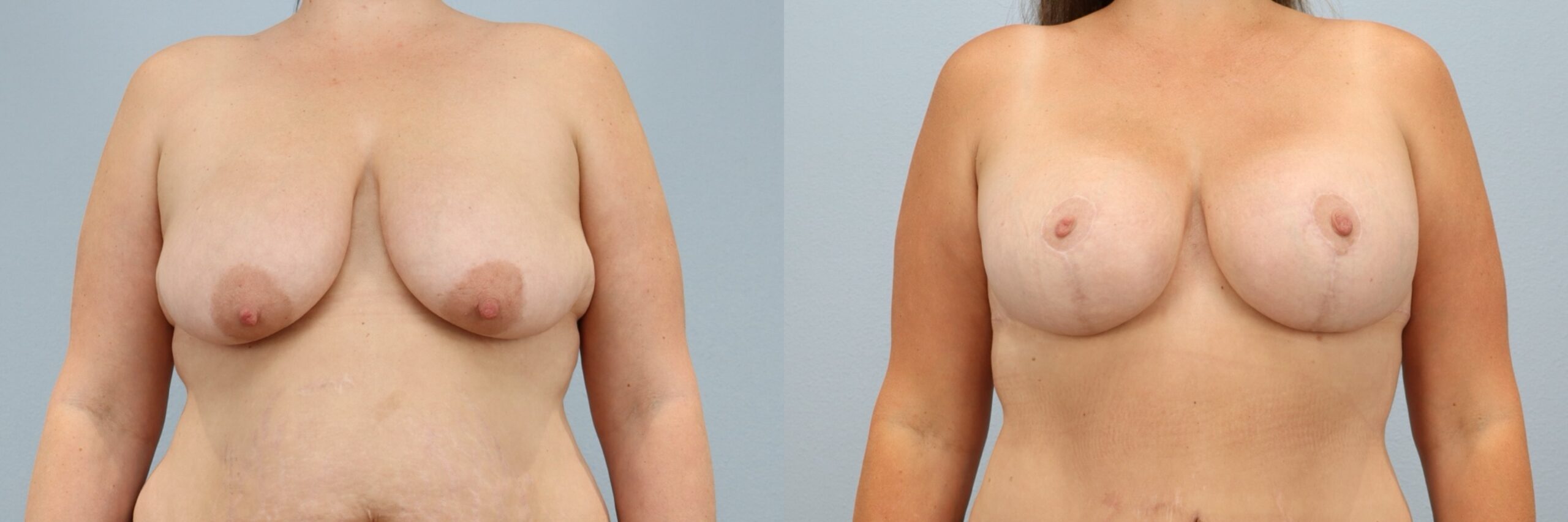 Before and after – Breast Lift With Implants – Female patient, age 40-49 – Image 58