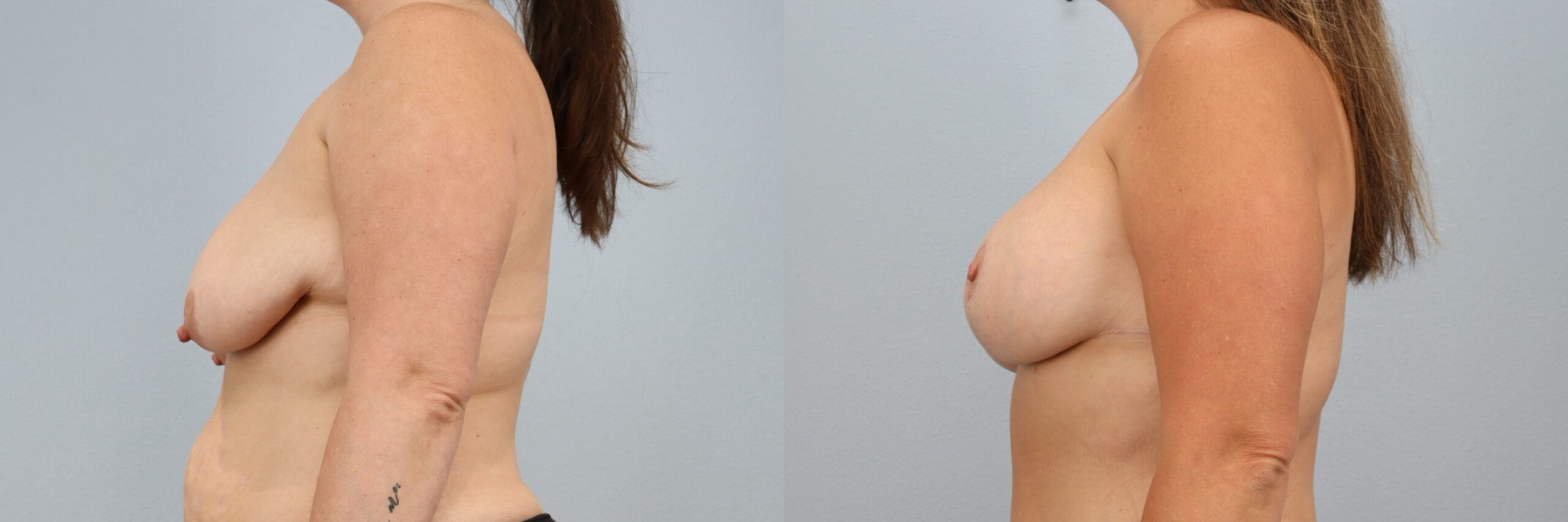 Before and after – Breast Lift With Implants – Female patient, age 40-49 – Image 60