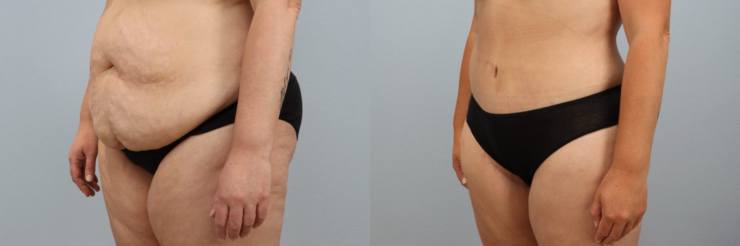 Before and after – Tummy Tuck – Female patient, age 40-49 – Image 11