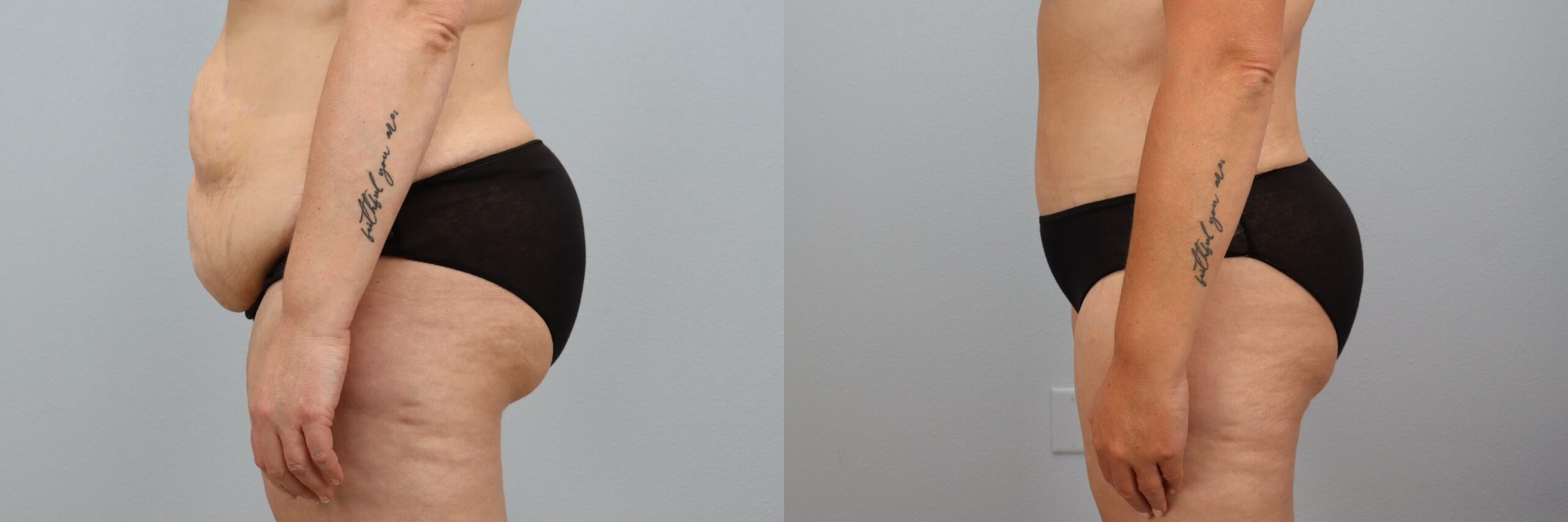 Before and after – Tummy Tuck – Female patient, age 40-49 – Image 12