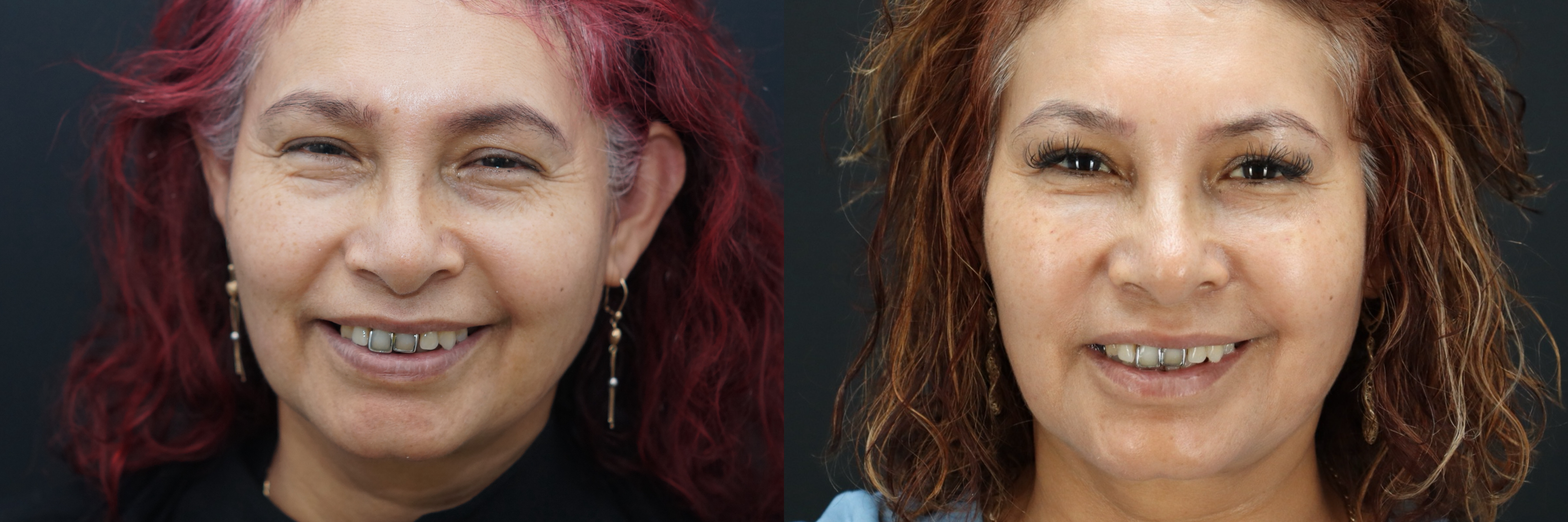 Before and after – BOTOX – Female patient, age 60+ – Image 22