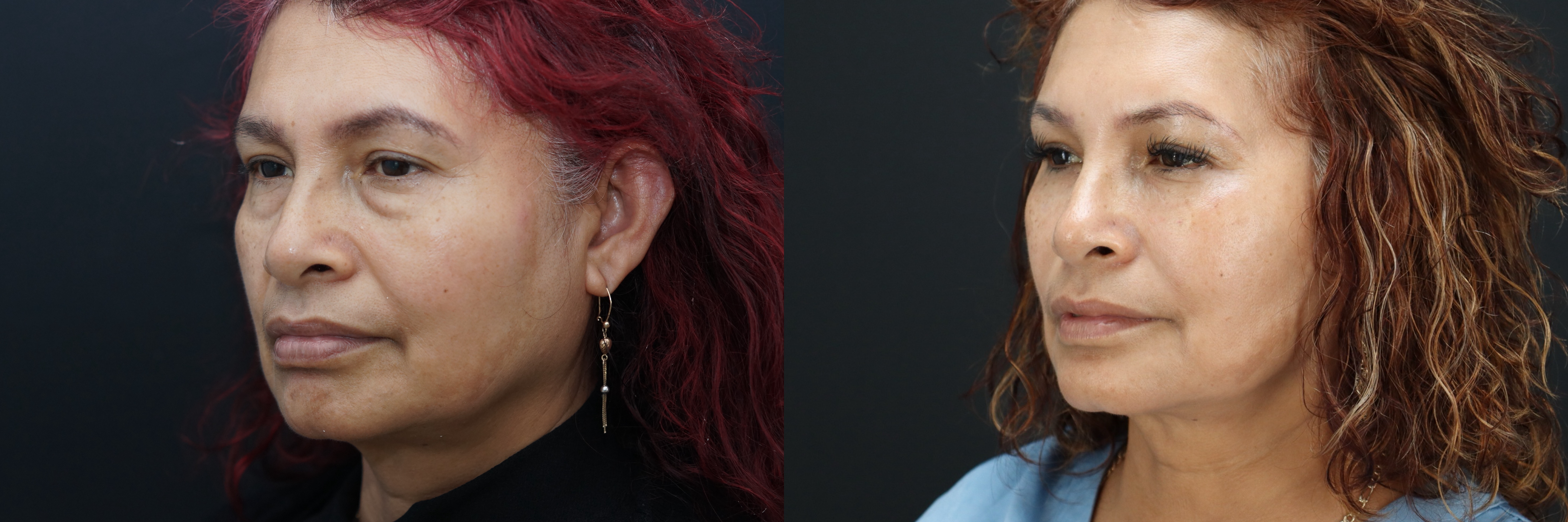 Before and after – BOTOX – Female patient, age 60+ – Image 23