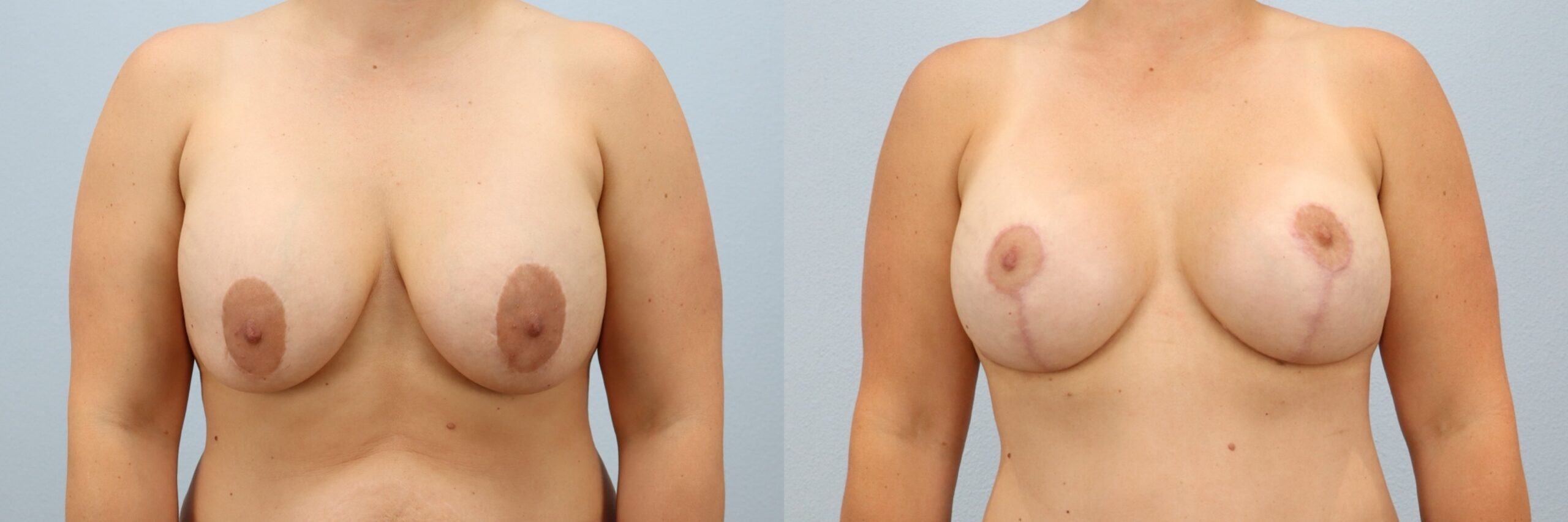 Before and after – Breast Revision – Female patient, age 40-49 – Image 25