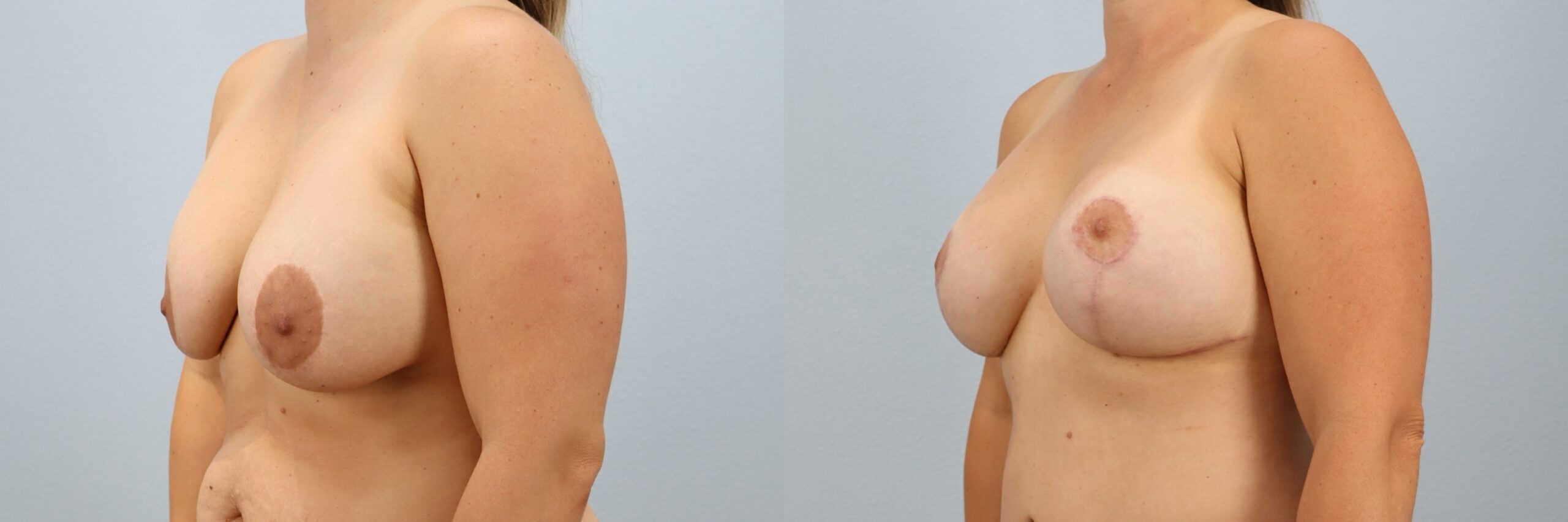 Before and after – Breast Revision – Female patient, age 40-49 – Image 26