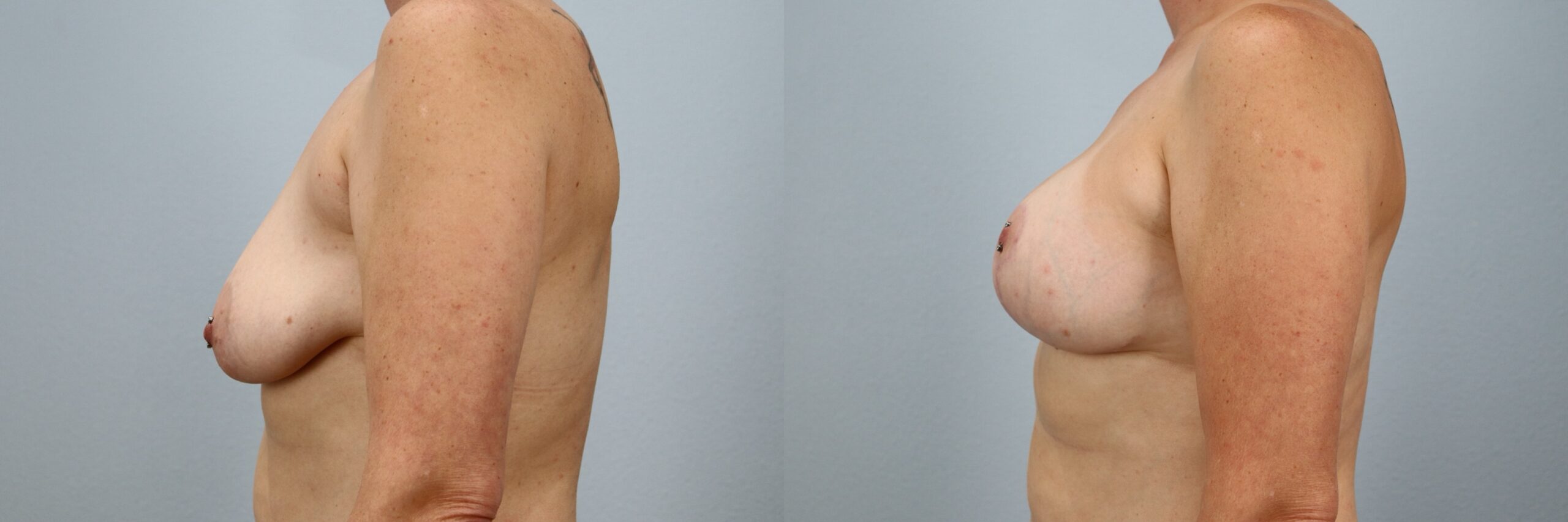 Before and after – Breast Surgery – Female patient, age 30-39 – Image 42