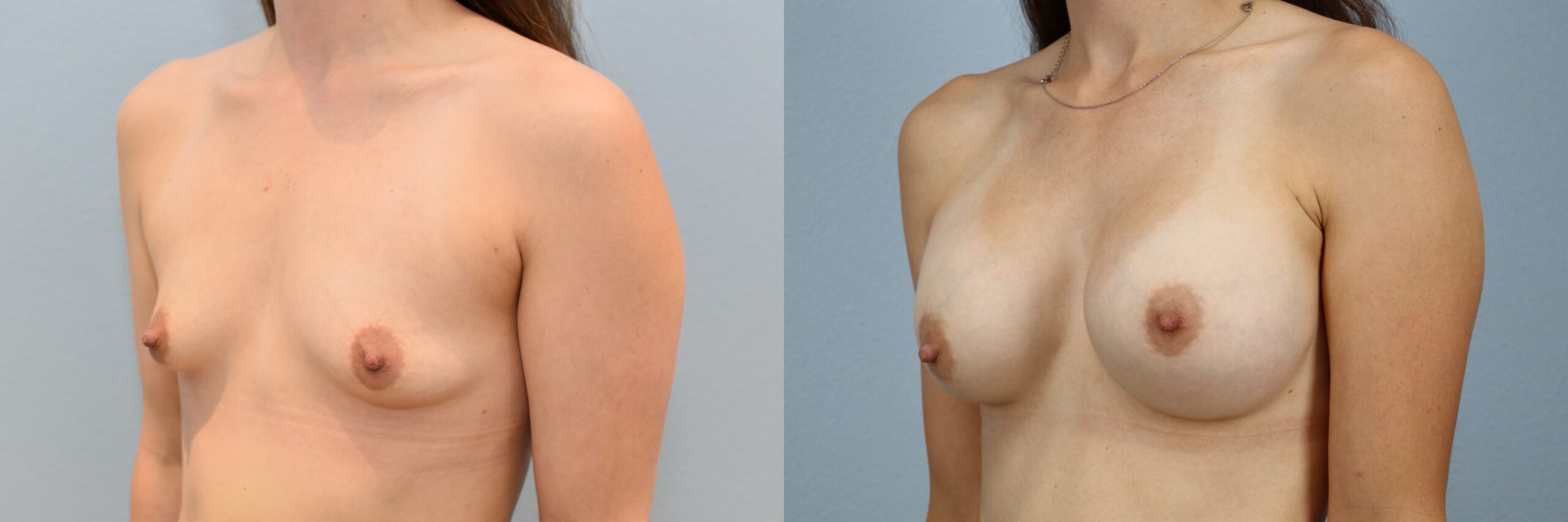 Before and after – Breast Augmentation – Female patient, age 20-29 – Image 56