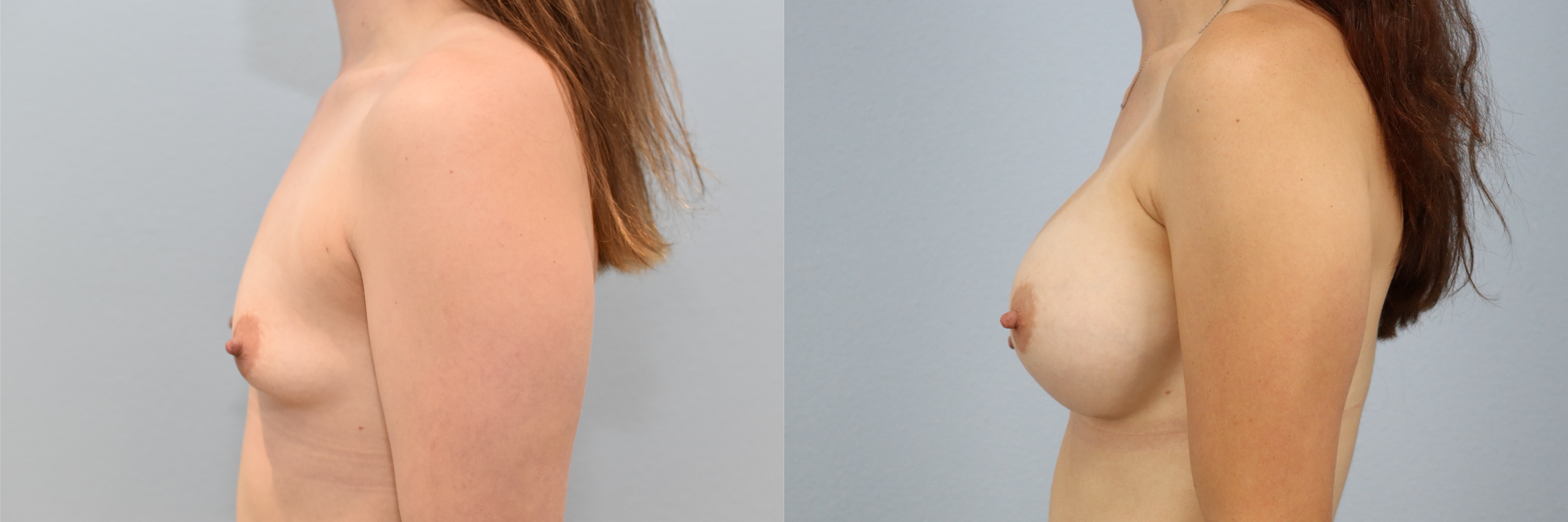Before and after – Breast Augmentation – Female patient, age 20-29 – Image 57