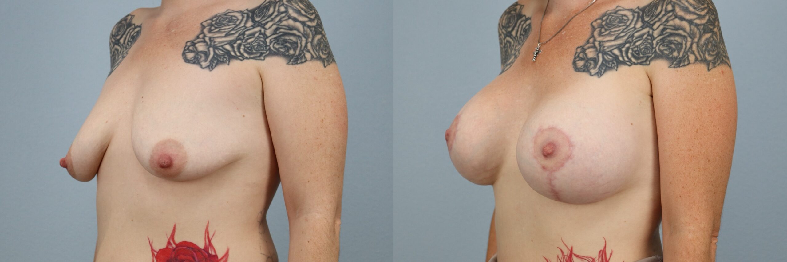 Before and after – Breast Surgery – Female patient, age 30-39 – Image 41