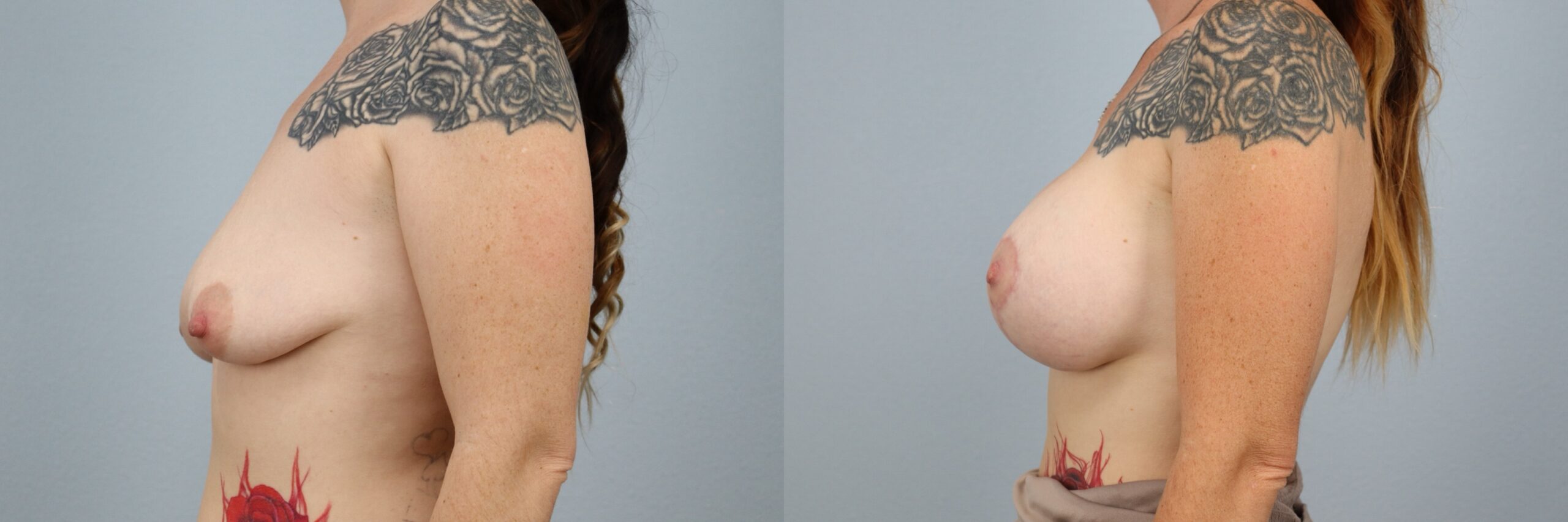 Before and after – Breast Surgery – Female patient, age 30-39 – Image 42