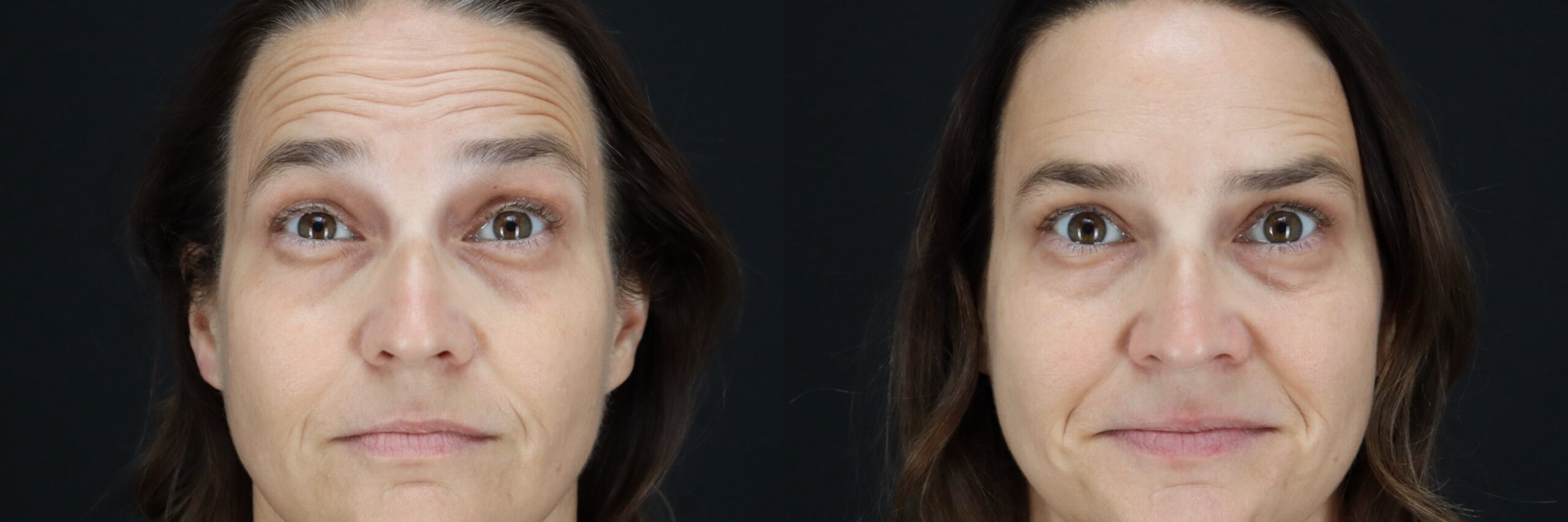 SR Botox Forehead, Glabella and Crows Feet Brows Raised