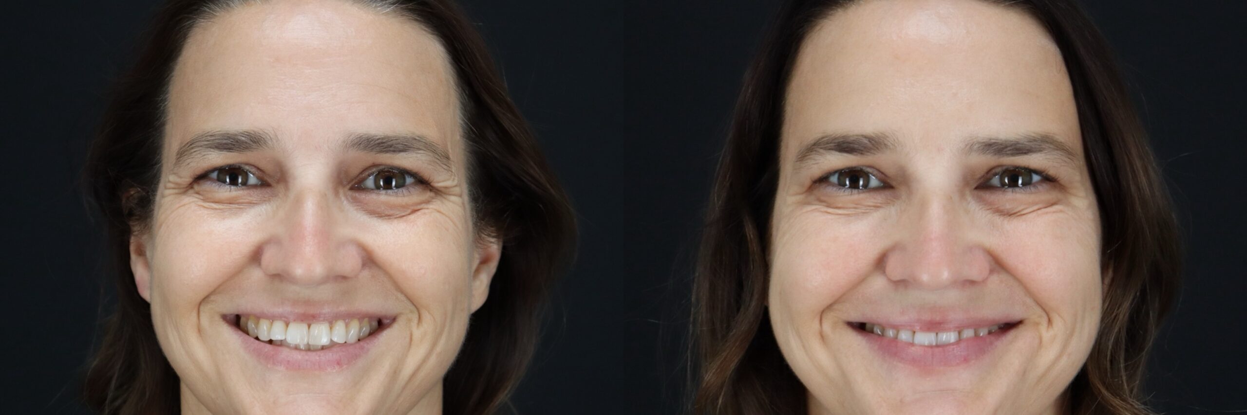 Before and after – BOTOX – Female patient, age 40-49 – Image 19