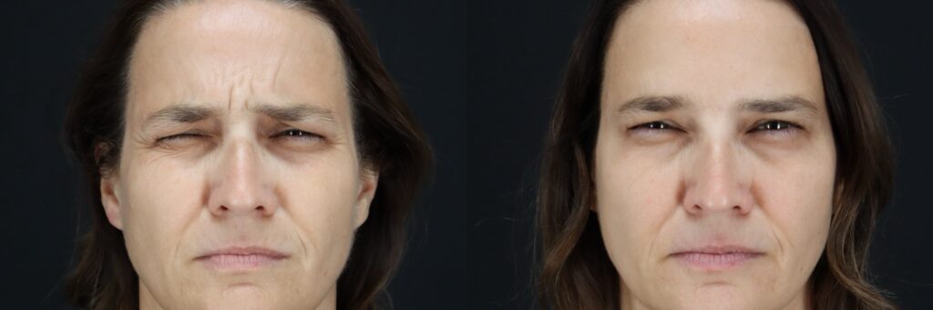 botox cost per unit