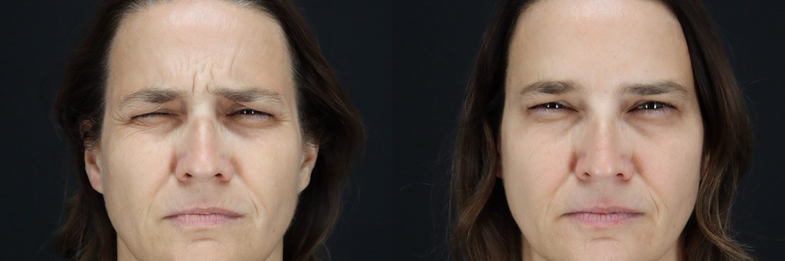 Before and after – BOTOX – Female patient, age 40-49 – Image 20