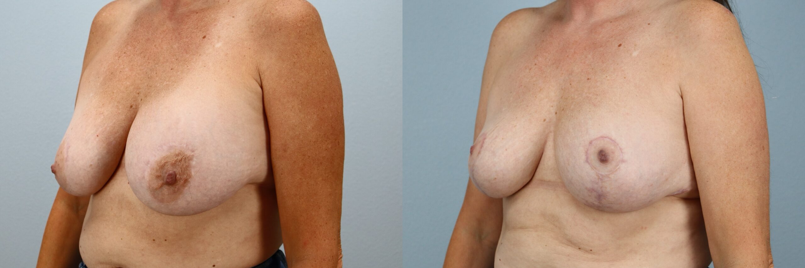 Before and after – Breast Surgery – Female patient, age 50-59 – Image 47