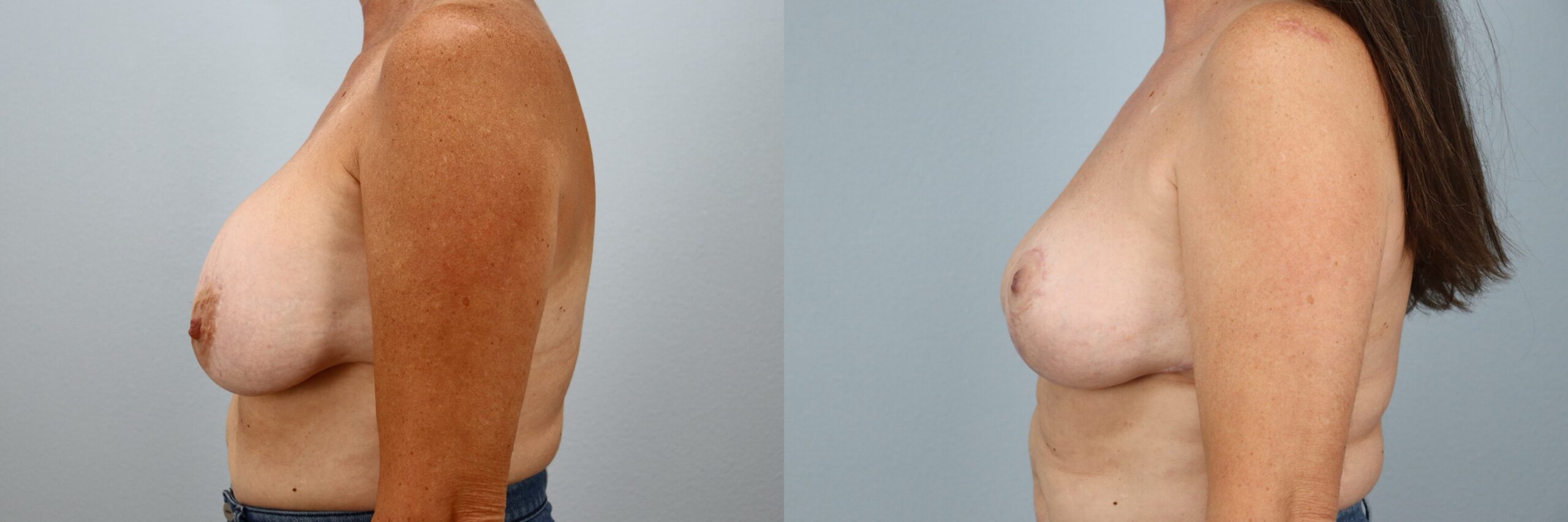 Before and after – Breast Surgery – Female patient, age 50-59 – Image 48