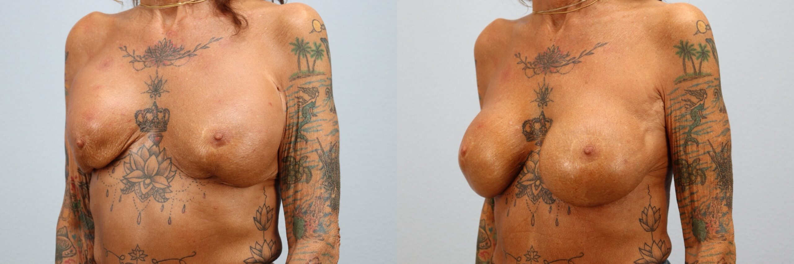Before and after – Breast Revision – Female patient, age 60+ – Image 35