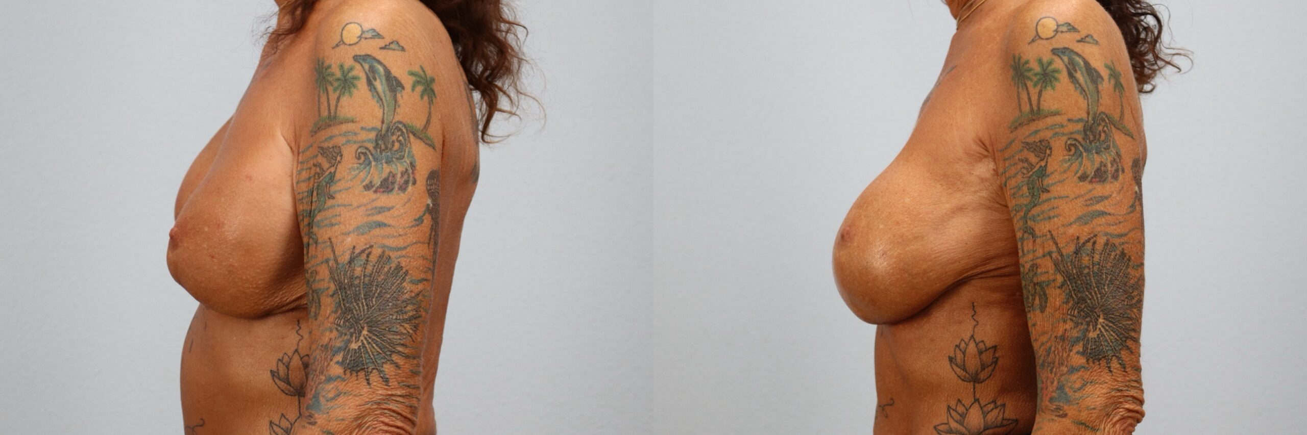Before and after – Breast Revision – Female patient, age 60+ – Image 36