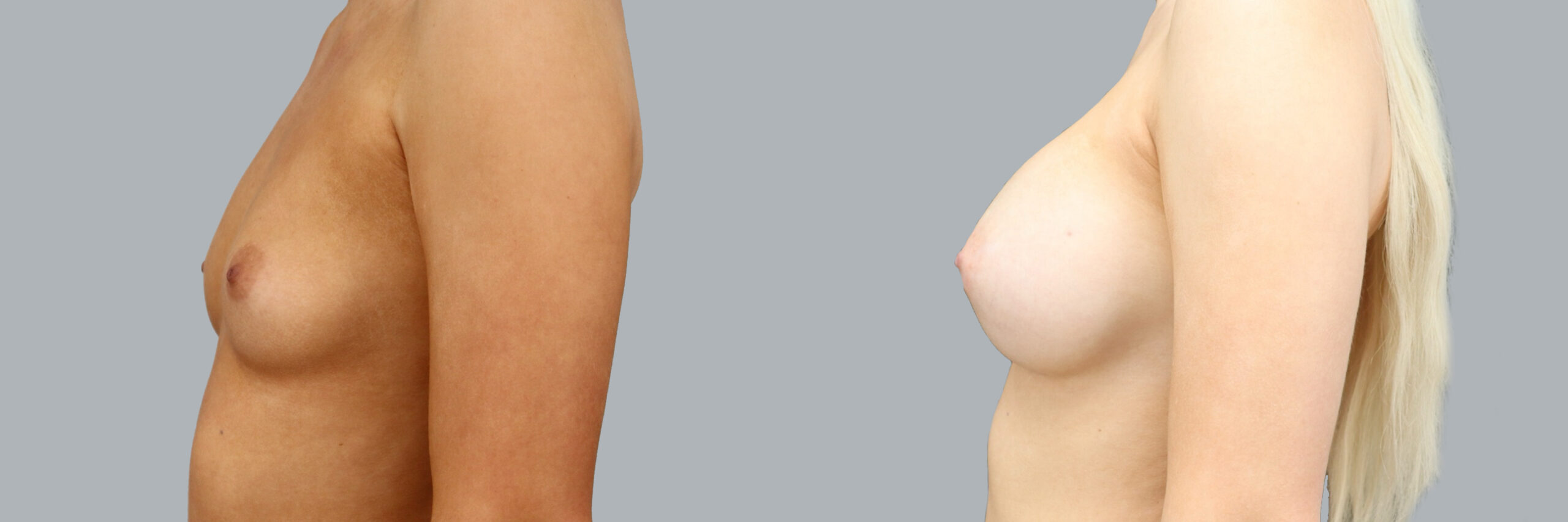 Before and after – Breast Surgery – Female patient, age 20-29 – Image 45