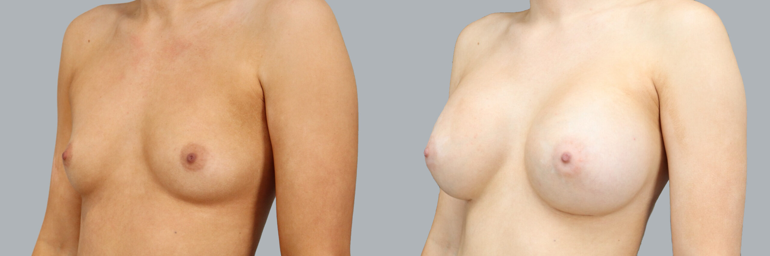 Before and after – Breast Surgery – Female patient, age 20-29 – Image 44