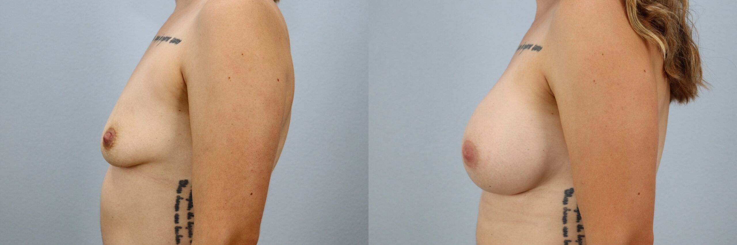 Before and after – Breast Augmentation – Female patient, age 30-39 – Image 57