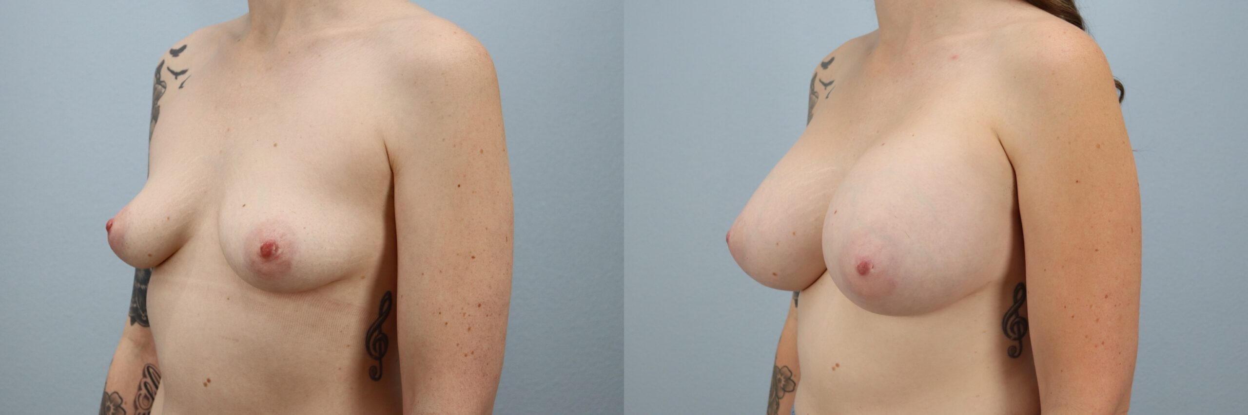 Before and after – Breast Surgery – Female patient, age 30-39 – Image 5