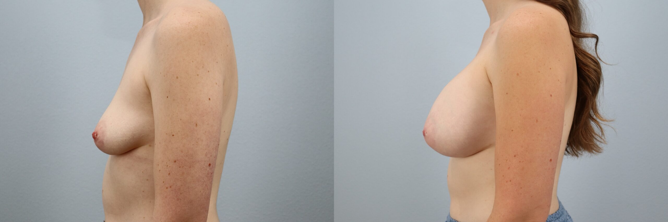 Before and after – Breast Surgery – Female patient, age 30-39 – Image 6