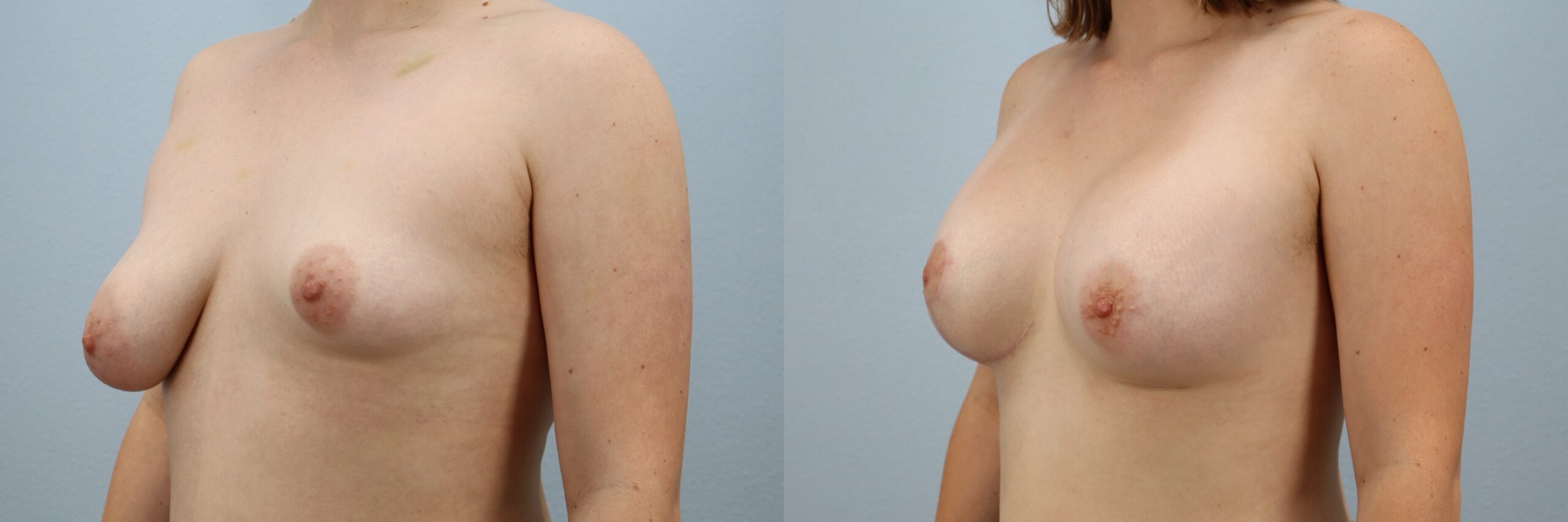 Before and after – Breast Lift With Implants – Female patient, age 20-29 – Image 44