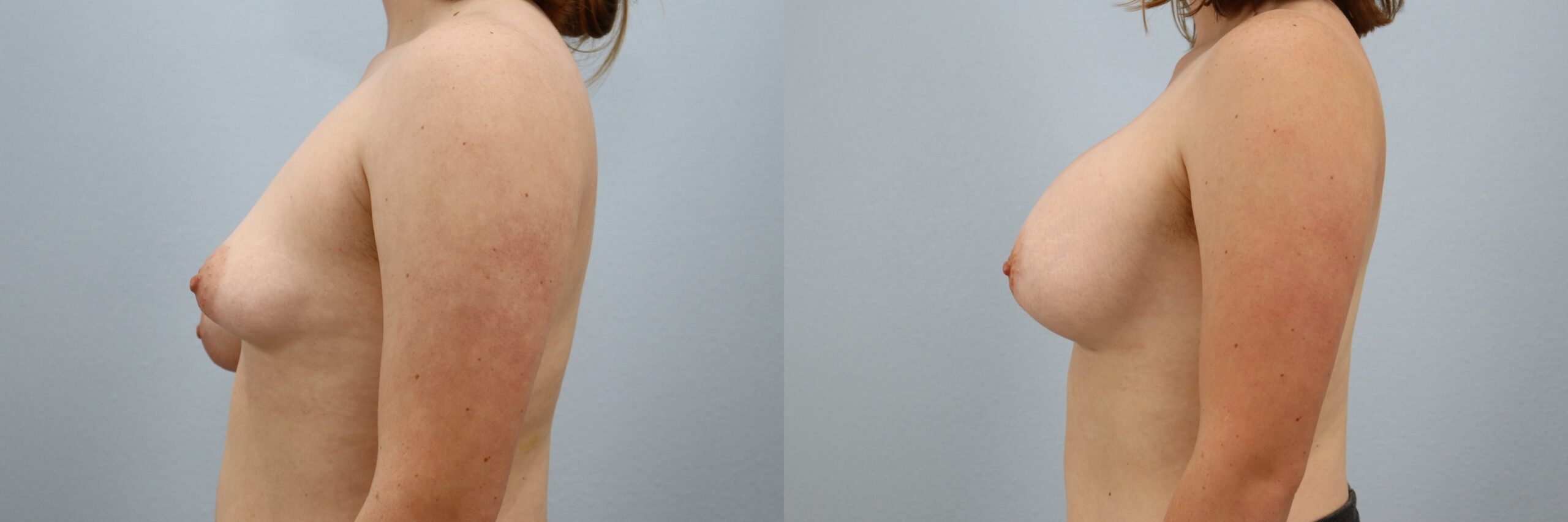 Before and after – Breast Lift With Implants – Female patient, age 20-29 – Image 45