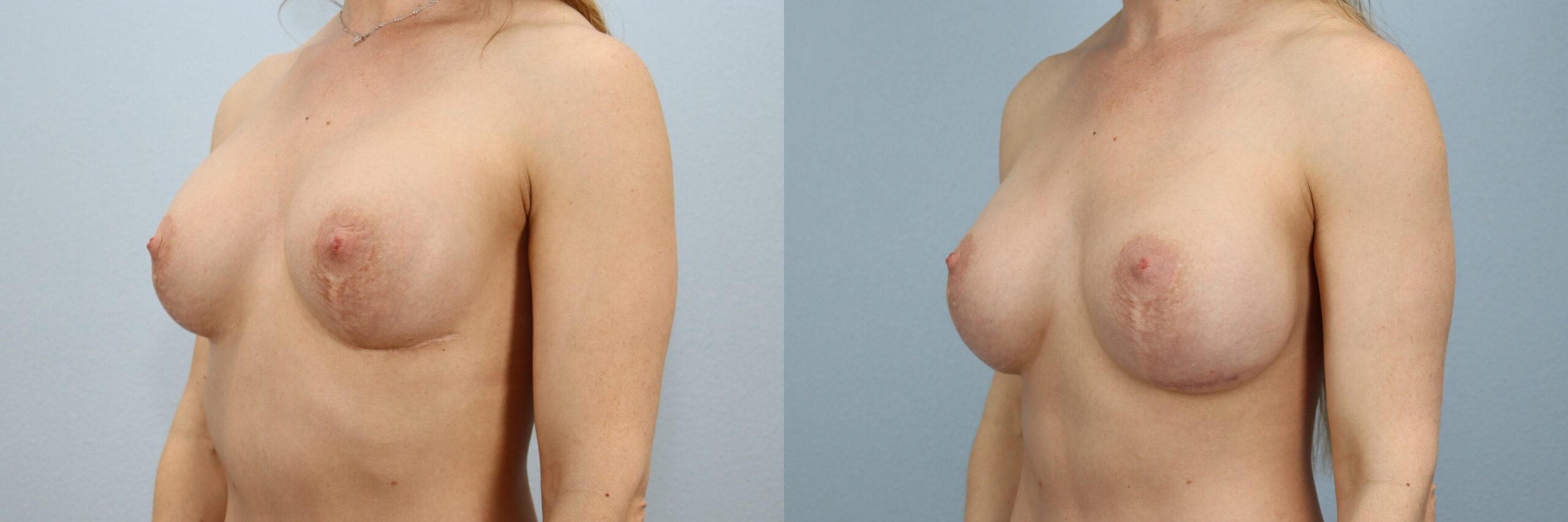 Before and after – Breast Revision – Female patient, age 40-49 – Image 32