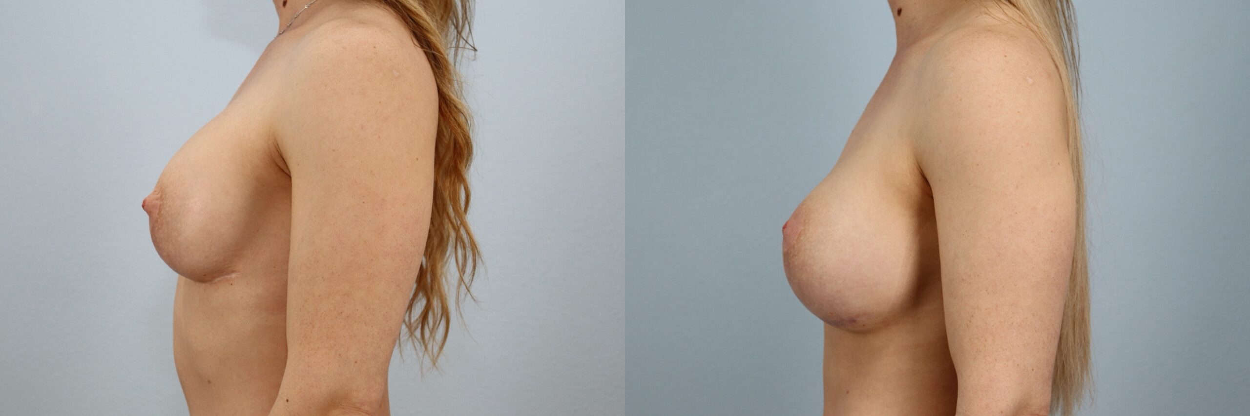Before and after – Breast Revision – Female patient, age 40-49 – Image 33
