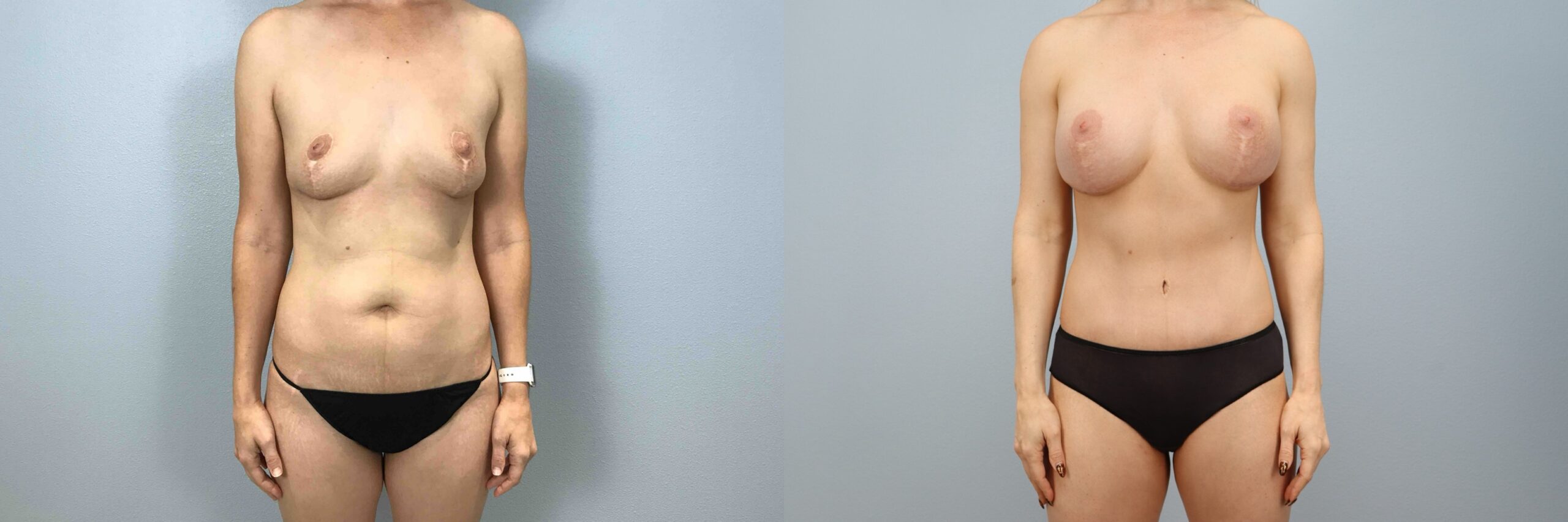 Before and after – Mommy Makeover – Female patient, age 40-49 – Image 37