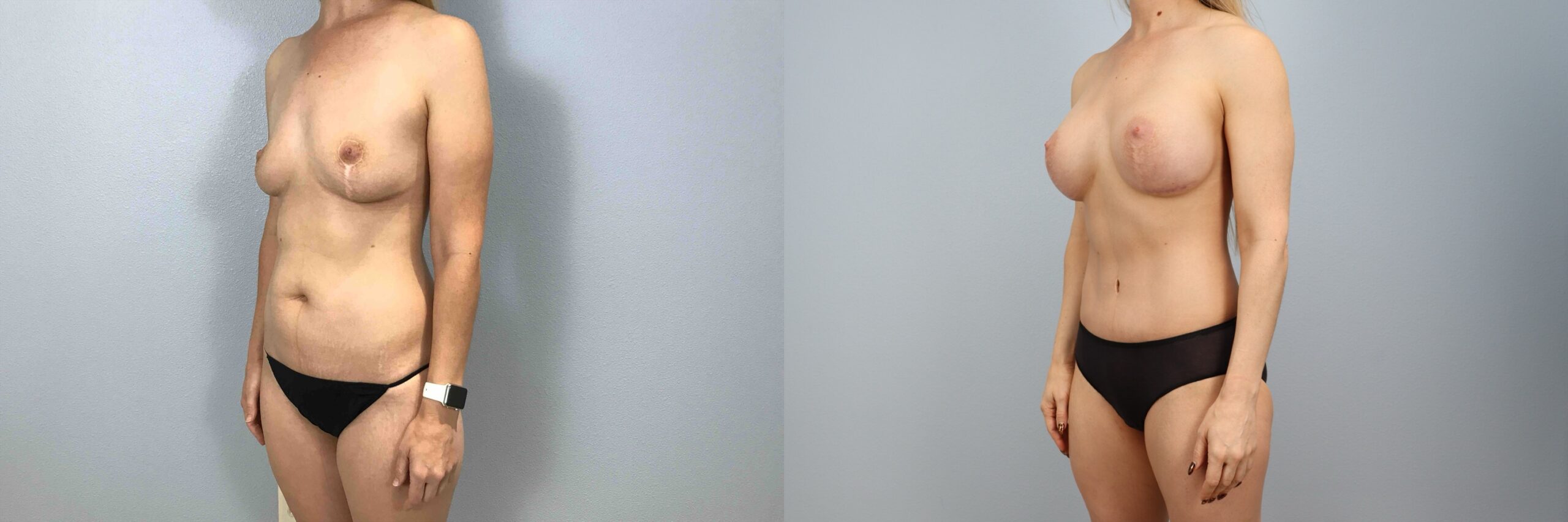 Before and after – Mommy Makeover – Female patient, age 40-49 – Image 38
