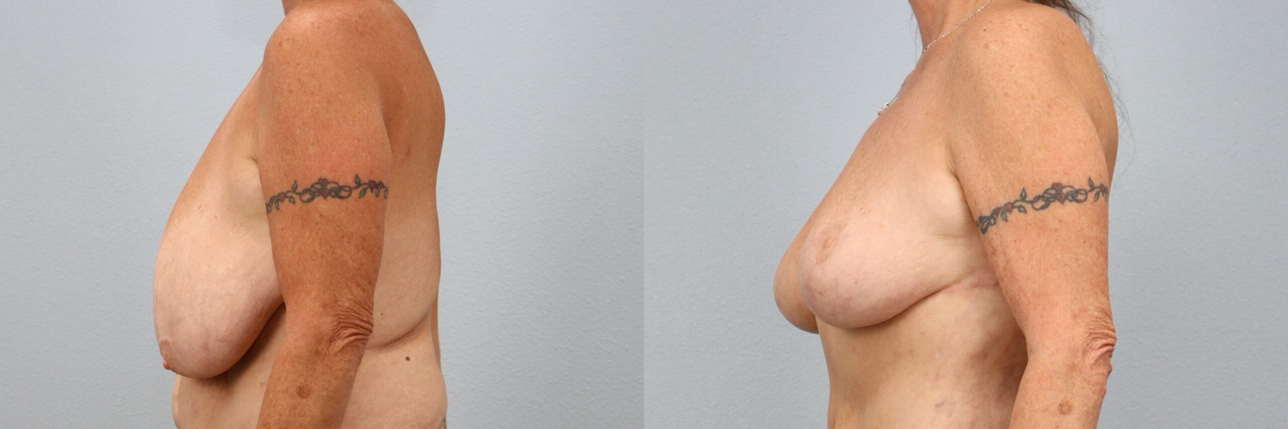 Before and after – Breast Reduction – Female patient, age 60+ – Image 30