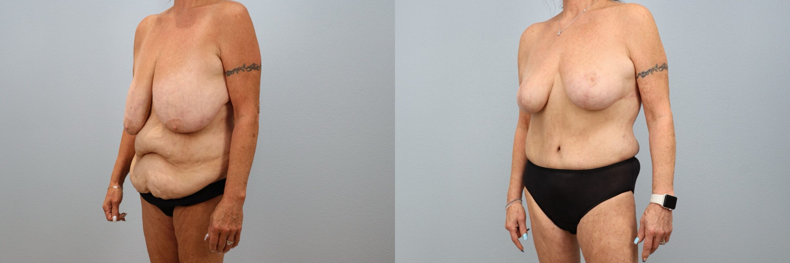 Before and after – Mommy Makeover – Female patient, age 60+ – Image 26
