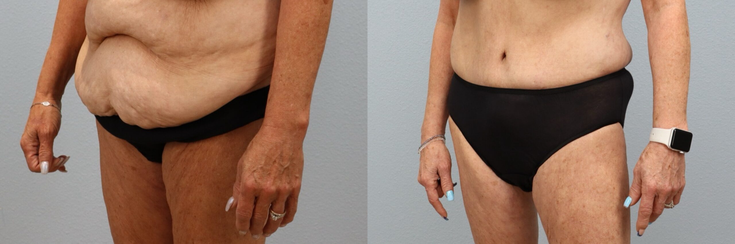 Before and after – Tummy Tuck – Female patient, age 60+ – Image 2