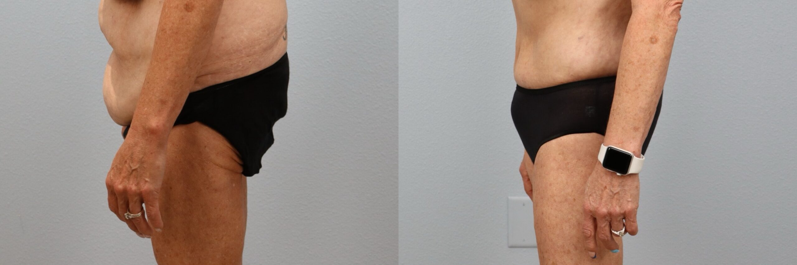 Before and after – Tummy Tuck – Female patient, age 60+ – Image 3