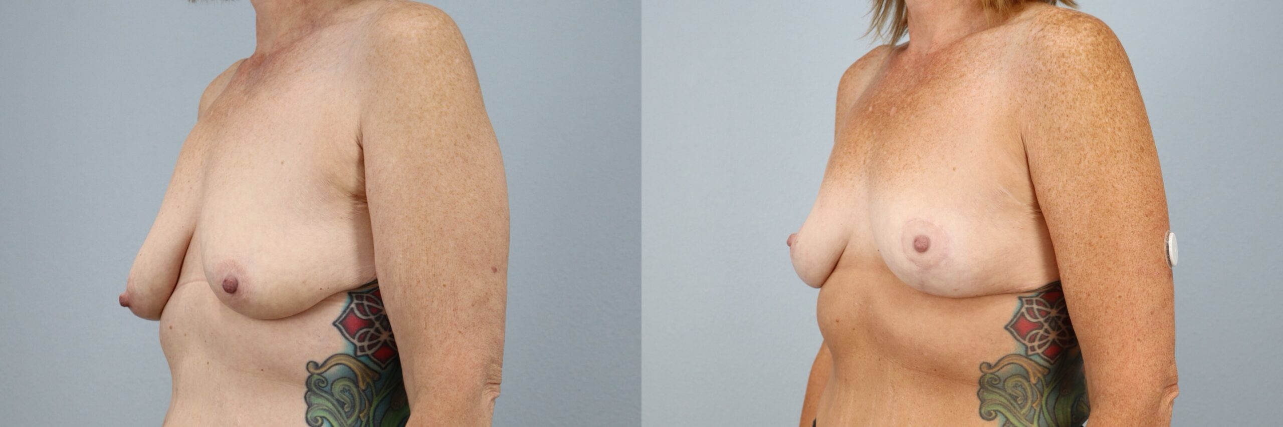 Before and after – Breast Surgery – Female patient, age 50-59 – Image 29