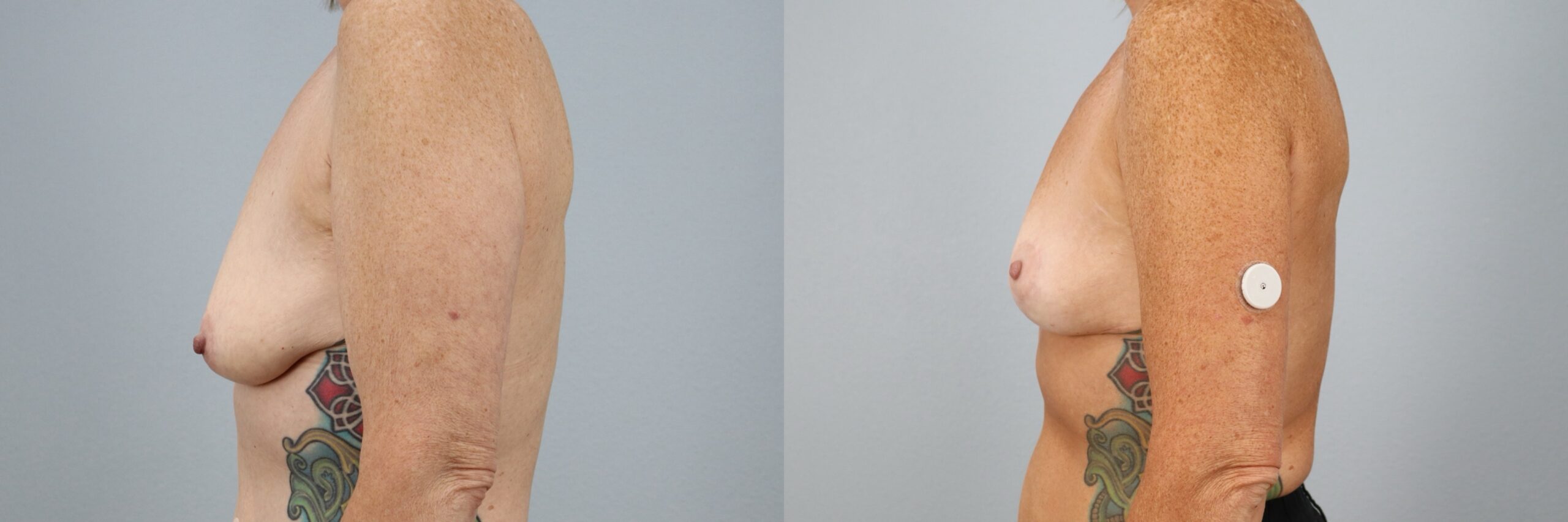 Before and after – Breast Surgery – Female patient, age 50-59 – Image 30